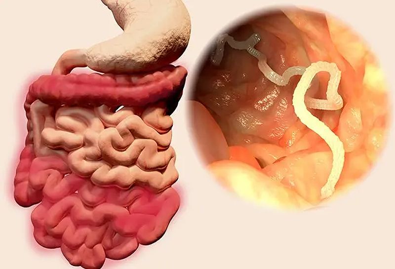 How To Get Rid Of Intestinal Worms: Natural Remedies, Medical Treatments, And Prevention